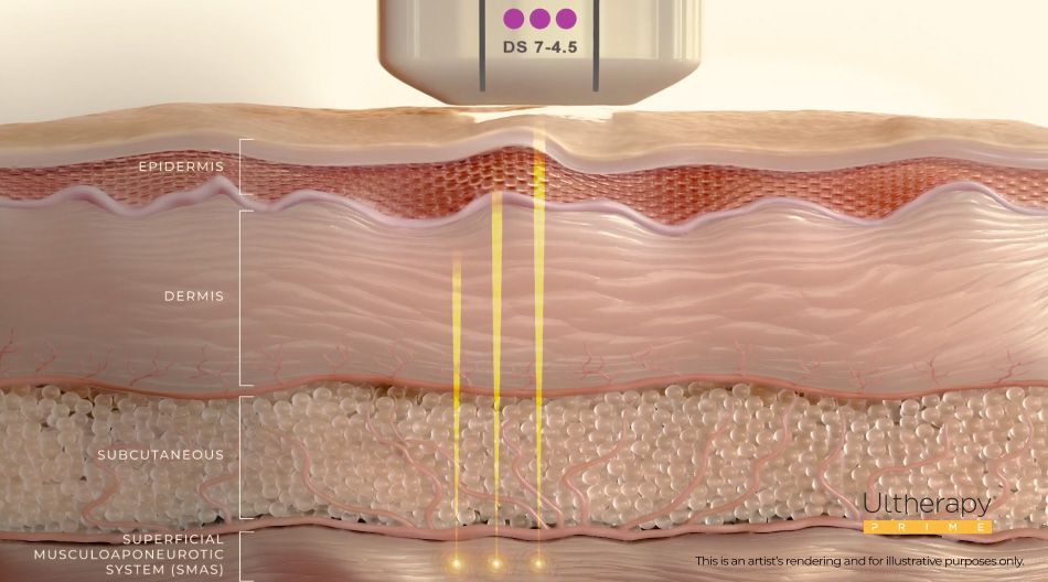 Ultherapy Machine Targeted Energy