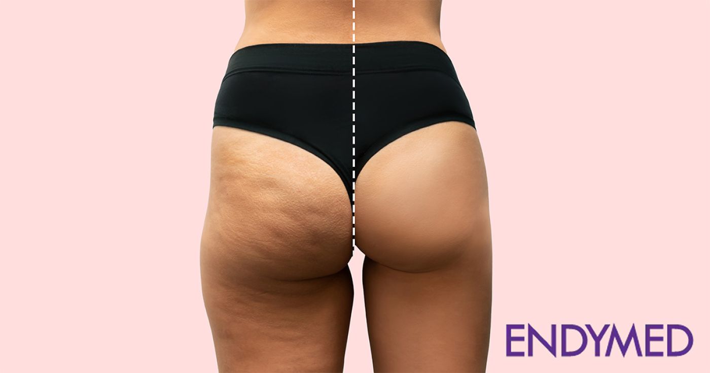 EndyMed Cellulite Reduction