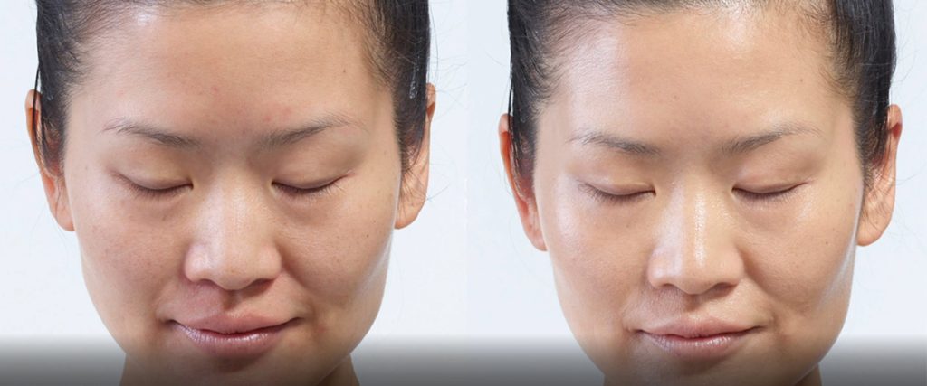Before and After DiamondGlow Facial